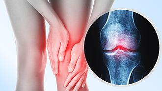 Artrosis en la articulación de la rodilla